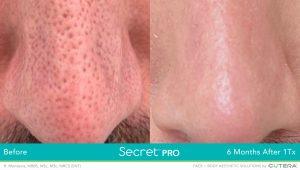 Secret Pro BA Mandavia | RSVP Beauty Clinic | Aesthetic Treatment Vancouver BC