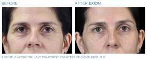 Exion PIC Ba card eyes female | RSVP Beauty Clinic | Aesthetic Treatment Vancouver BC